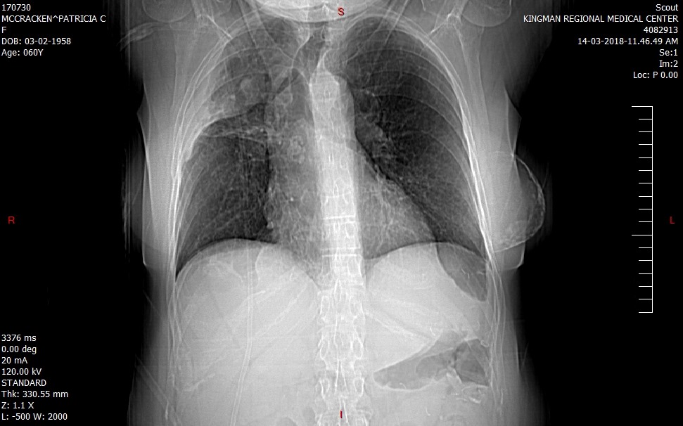 Emphysema related death